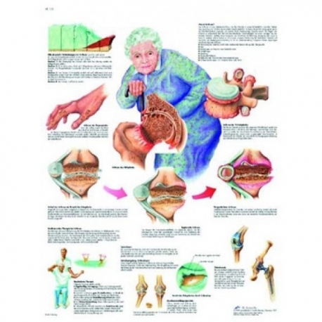 Lamina 3B Artrosis